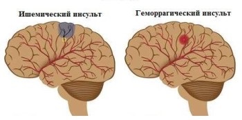 MRI diagnózis agyi erek (angiográfia) - Leírás és címét klinikák