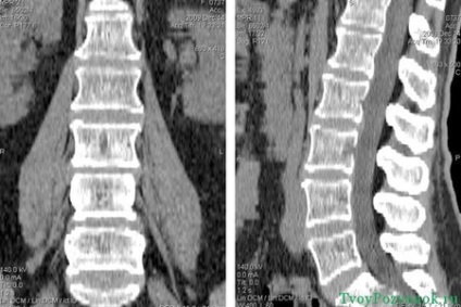 MRI vagy CT a gerinc, ami jobb