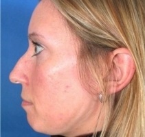 Sasorr - okai és tünetei az orr egy púp