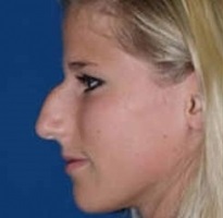 Sasorr - okai és tünetei az orr egy púp