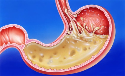 Homoktövis olaj gastritis kezelésére, erozív gastritis és atrófiás, fokozott (olaj) A homoktövis olaj gyomorhurut kezelésére, erozív gastritis és a sorvadásos, fokozott