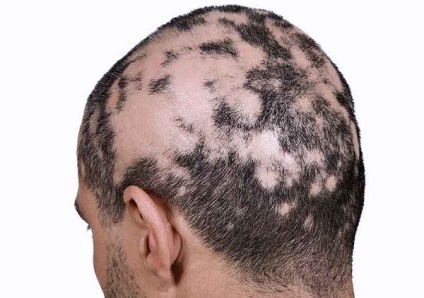 Foltos kopaszodás okoz hajhullást vagy beágyazás, mi ez, és hogy vannak-e visszaesés