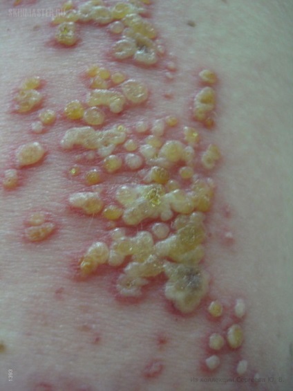Herpes zoster Herpes népi jogorvoslati kezelés () Herpes zoster kezelésére emberek jogorvoslatok