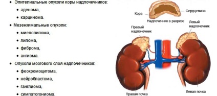 A tumor a mellékvesék tünetek és kezelés