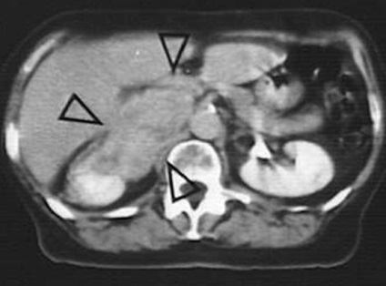 A tumor a mellékvesék tünetek és kezelés