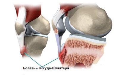 Osteohondropatija sípcsont tuberosity