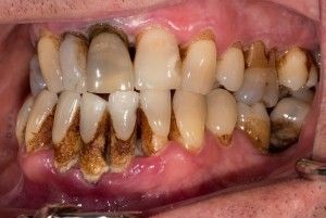Akut periodontiíissei tünetek, okok és a tünetek