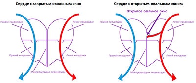 Nyitott foramen ovale, a szív a gyermeknek, hogyan kell kezelni