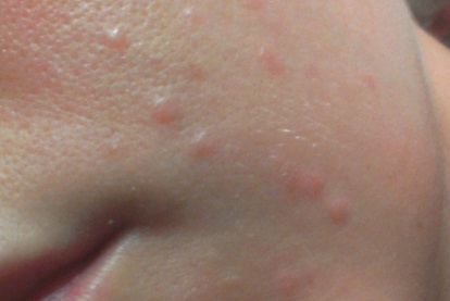 Papilloma virus vaccino ai maschi - Hpv szemolcs arcon - Enterobius vermicularis yumurtas nedir