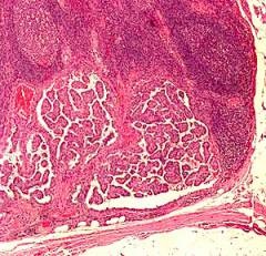 Papilláris karcinóma (karcinóma, adenokarcinóma), pajzsmirigy tünetek, különösen microcarcinoma