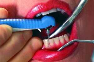 A periodontális (gumi) zseb abrasióval és gumi kezelés a fogak között (fotó)