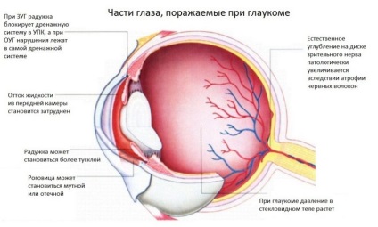 Az első jelei glaukómás szemekben - Tünetek, típusok és kezelés