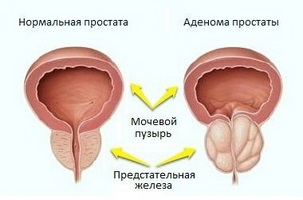 Propoliszt hatékony szer BPH kezelésére