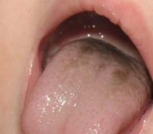 Foltok a nyelv a gyermek okozza a megjelenése fehér, piros csecsemő