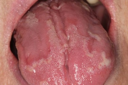Foltok a nyelv a gyermek okozza a megjelenése fehér, piros csecsemő