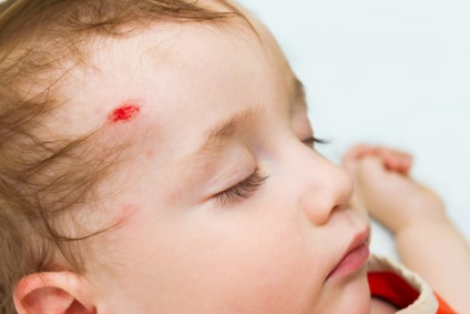 A gyermek esett vagy vágtuk elsősegélyt nyújtani sérülések