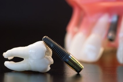 Az élettartam a fogászati implantátumok (időszak) Az élettartam a fogászati implantátumok