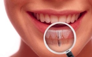 Az élettartam a fogászati implantátumok (időszak) Az élettartam a fogászati implantátumok