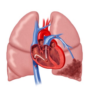 tüdőembólia