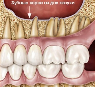 Lehetséges szövődmények eltávolítása után a fogak cikk