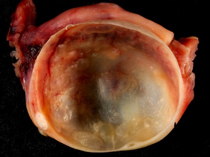 Egy kövér szeletet vagy fibroadenoma lehetséges megkülönböztetni a tumor