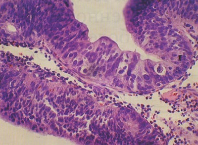 Adenomák a gasztrointesztinális traktus (adenomatózus polipok)