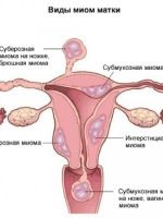 Antibakteriális gyógyszer nőgyógyászati (gyógyszerek) Antibakteriális szerekre Nőgyógyászati