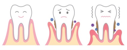 Érintő betegségek a fogíny - típusú ínybetegségek, kezelése és megelőzése