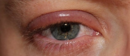 Forraljuk a szem kezelésére, okai tünetek