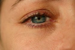 Forraljuk a szem kezelésére, okai tünetek