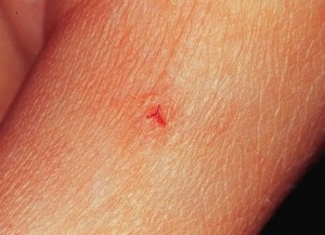 Mi a teendő, ha megharapott egy pióca harapást! (Leech) Mi a teendő, ha megharapott egy pióca harapást!