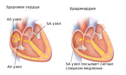 Mi van, ha bradycardia otthon, mint a gyógyítás