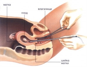 Mi az abortusz