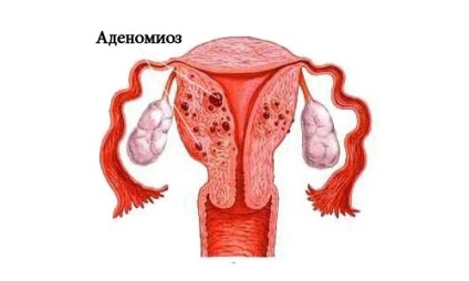 Mi diffúz adenomyosis (diffúz) Mi diffúz adenomyosis