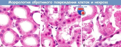 Mi nekrózis nekrózis morfológiája (nekrotikus sejtek lehetnek) Mi a morfológia nekrózis nekrózis