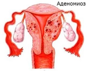 Diffúz méh adenomiózis tüneteket, formája, mértéke és kezelésük