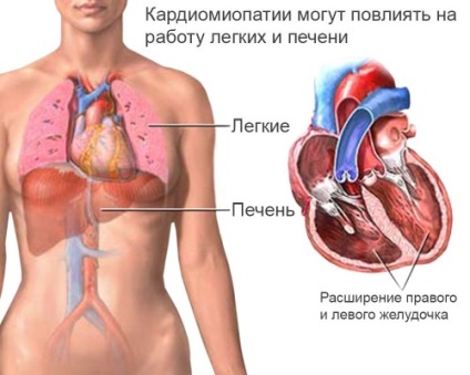 Dyshormonal kardiomiopátia tünetek és a kezelés 1