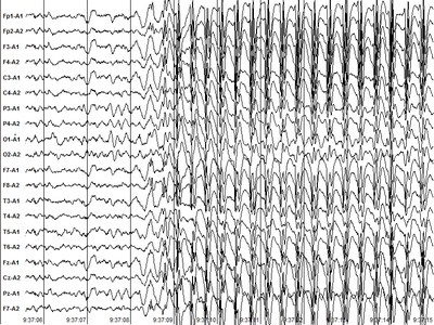 EEG és REG