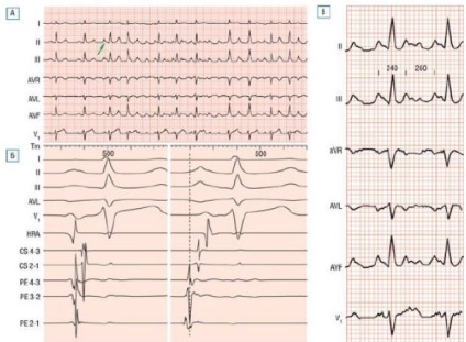 EKG pitvari tachycardia