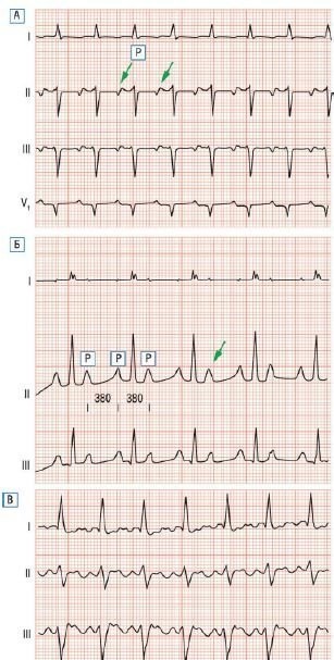EKG pitvari tachycardia