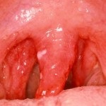 Herpeszes pharyngitis fotó, tünetei és kezelése