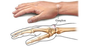 Sérv karján - okai, tünetei és kezelési módszerek