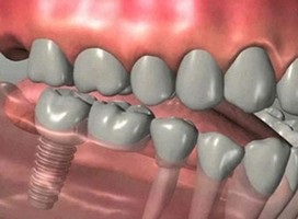Beültetés klinika fogak
