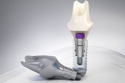 Az implantátumok STRAUMANN betegtájékoztatót (Straumann implantátum) Straumann implantátumok betegtájékoztatás