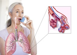 Inhalátorok az asztma