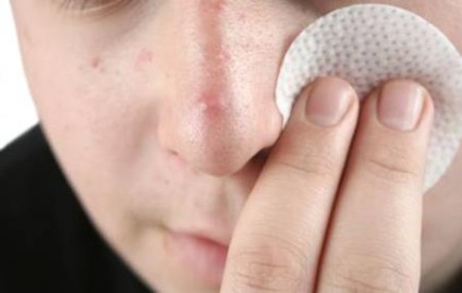 Hogyan kell kezelni a serdülőkori pattanások az arcon, minden a pattanások kezelésére