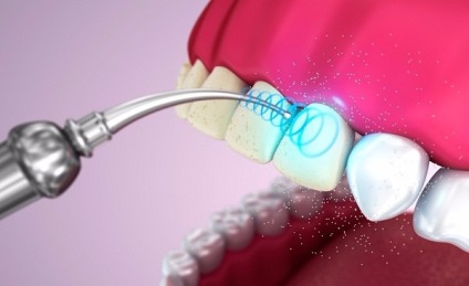 Hogyan kell kezelni a plakk a fogászatban és amit az orvos eltávolítja, gyönyörű