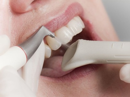 Hogyan kell kezelni a plakk a fogászatban és amit az orvos eltávolítja, gyönyörű