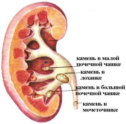 Kövek a méret a vesék, amelyek szabadon visszavonhatja