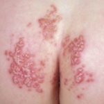 Candida dermatitis - ez egy fotó, tünetek, kezelés